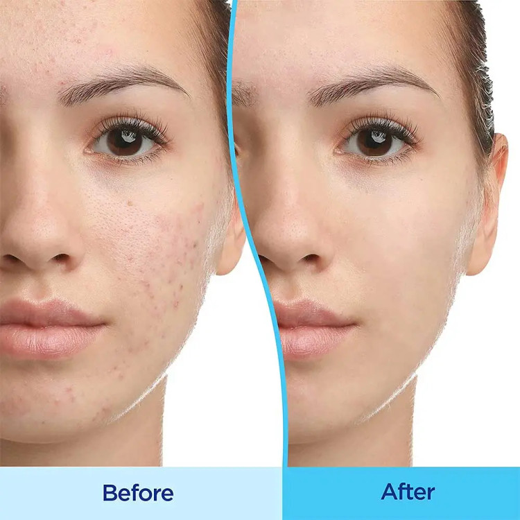 ژل ضدجوش و لایه بردار دیفرین