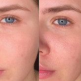 آمپول سنتلا ماداگاسکار SKIN1004 آبرسان و ترمیم کننده
